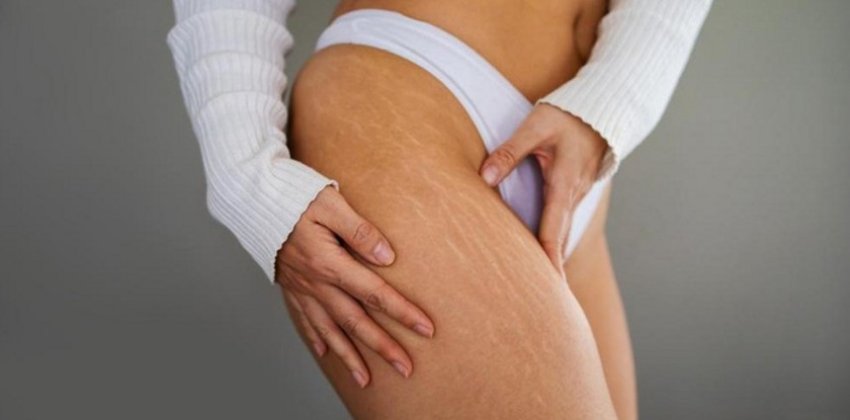 Растяжки на коже у женщин - «Здоровье»